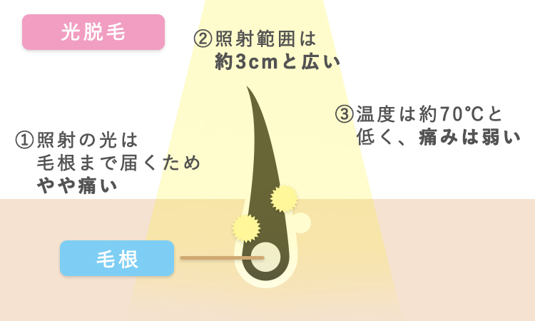 脱毛サロンが行う 光脱毛 の種類や仕組みとは 脱毛で後悔する前にチェック 脱毛love