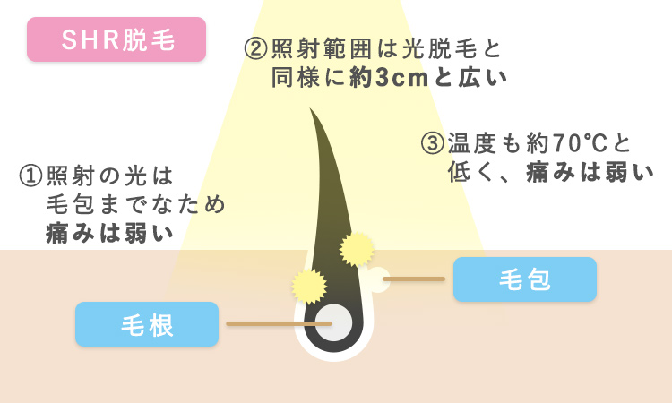 脱毛サロンが行う 光脱毛 の種類や仕組みとは 脱毛で後悔する前にチェック 脱毛love